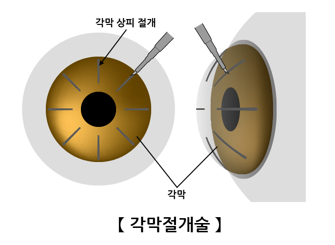 각막절개술(Keratotomy) | 검사/시술/수술정보 | 의료정보 | 건강정보 | 서울아산병원